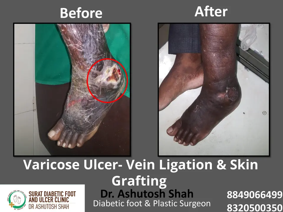 Diabetic Foot  PPT 3 checked by sir.pptx-64.webp